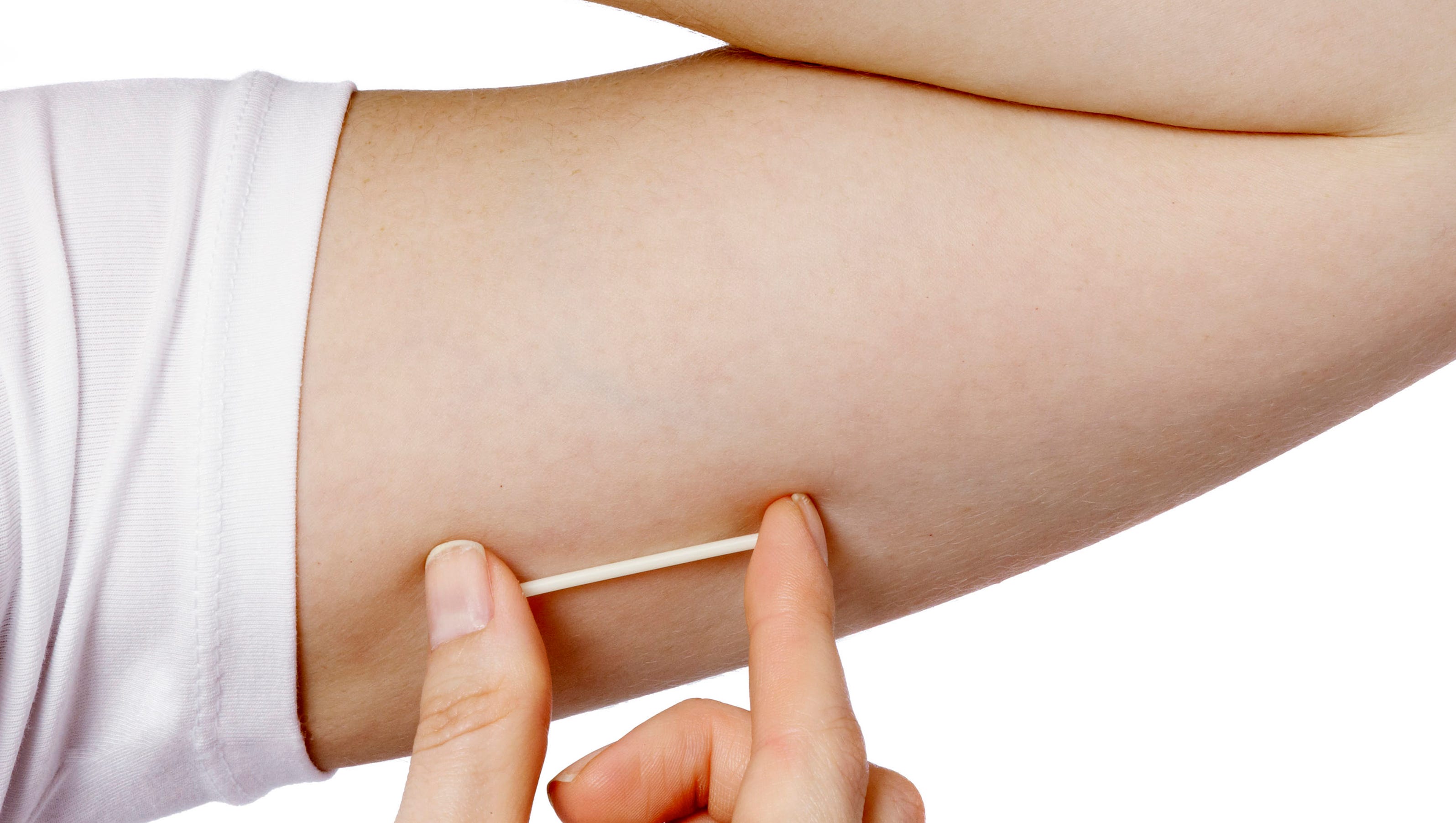 Icd 10 Code For Contraceptive Implant Removal