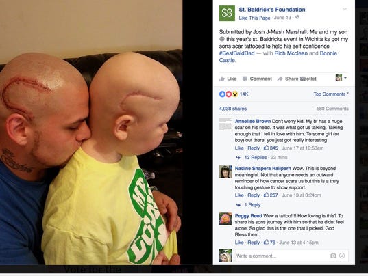 Dad Gets Tattoo To Match His Son S Brain Surgery Scar
