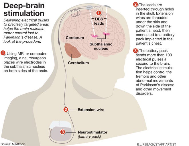 Parkinson's Disease Destroyed My Life. Then I Tried Deep Brain Stimulation.  