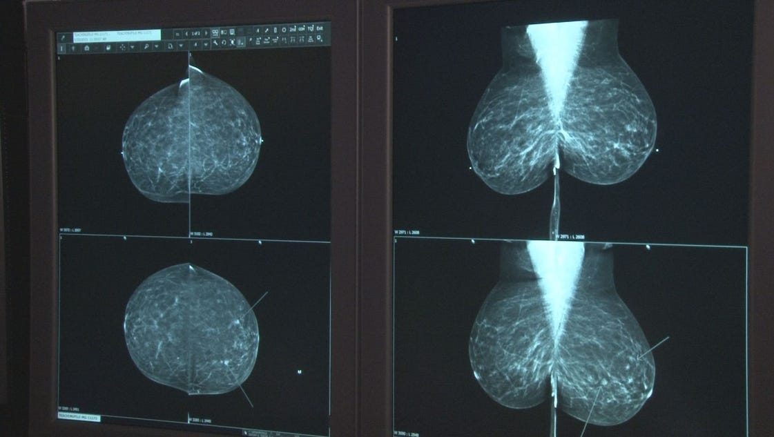 Dense Breast Tissue And Mammogram Report