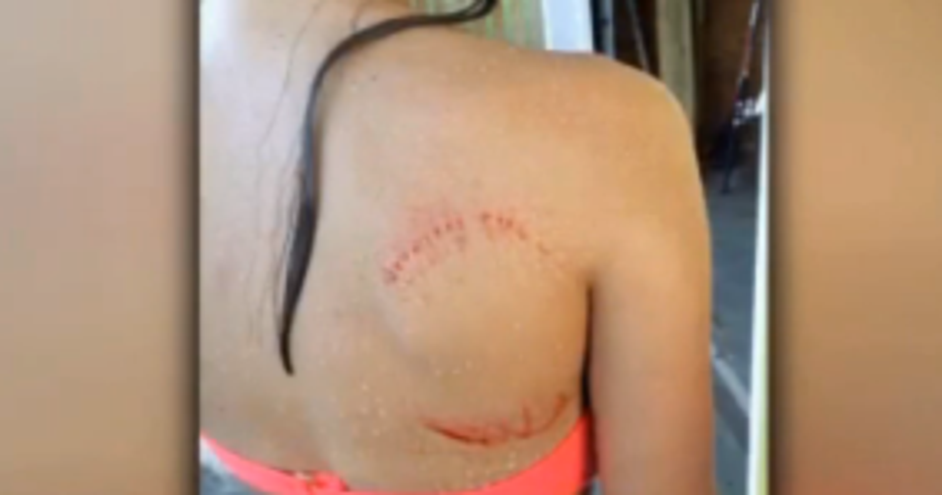 shark-leaves-huge-bite-marks-on-teen