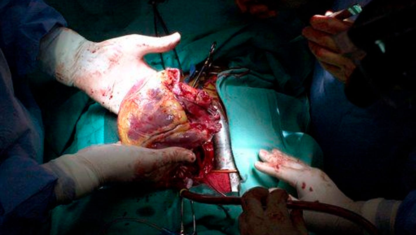 Worlds First Dead Heart Transplants Successful