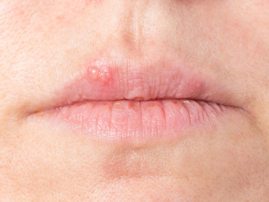 Home remedies: coping with cold sores