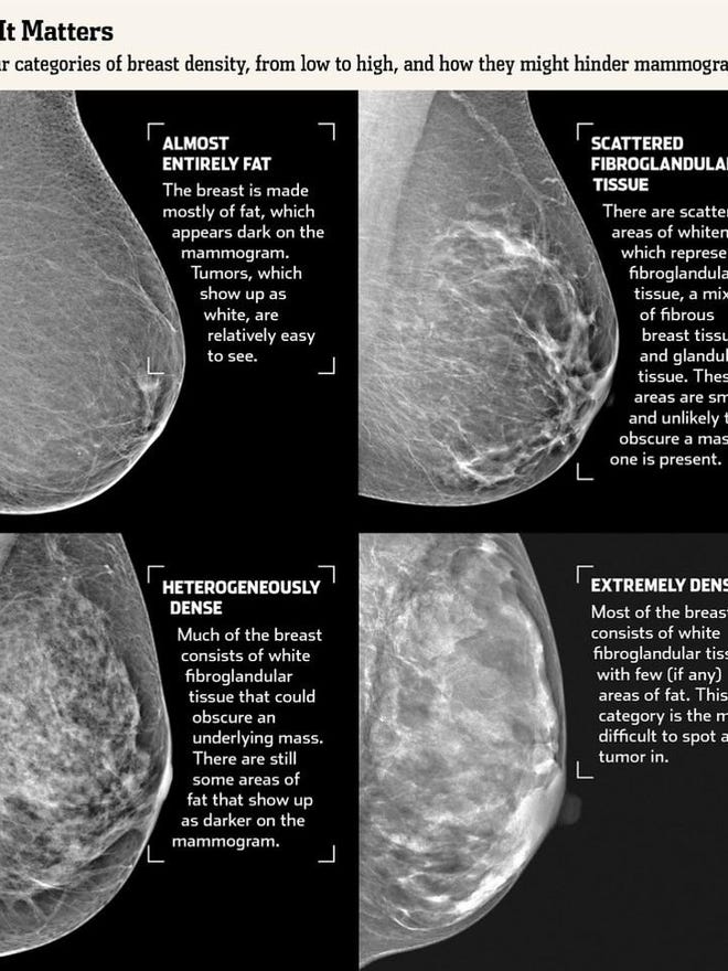 Vt Will Require Alerts About Breast Density