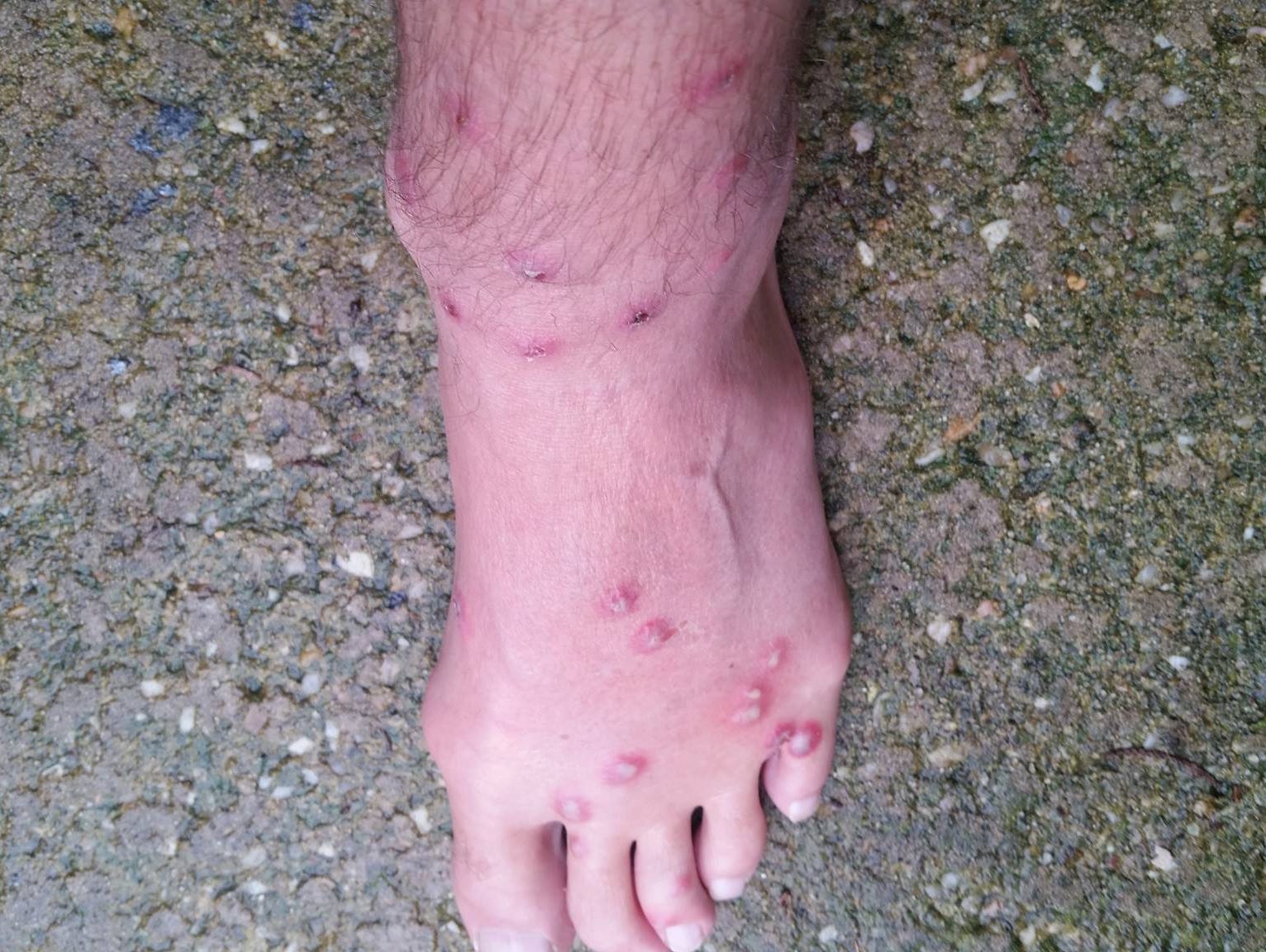 pictures of swimmers itch