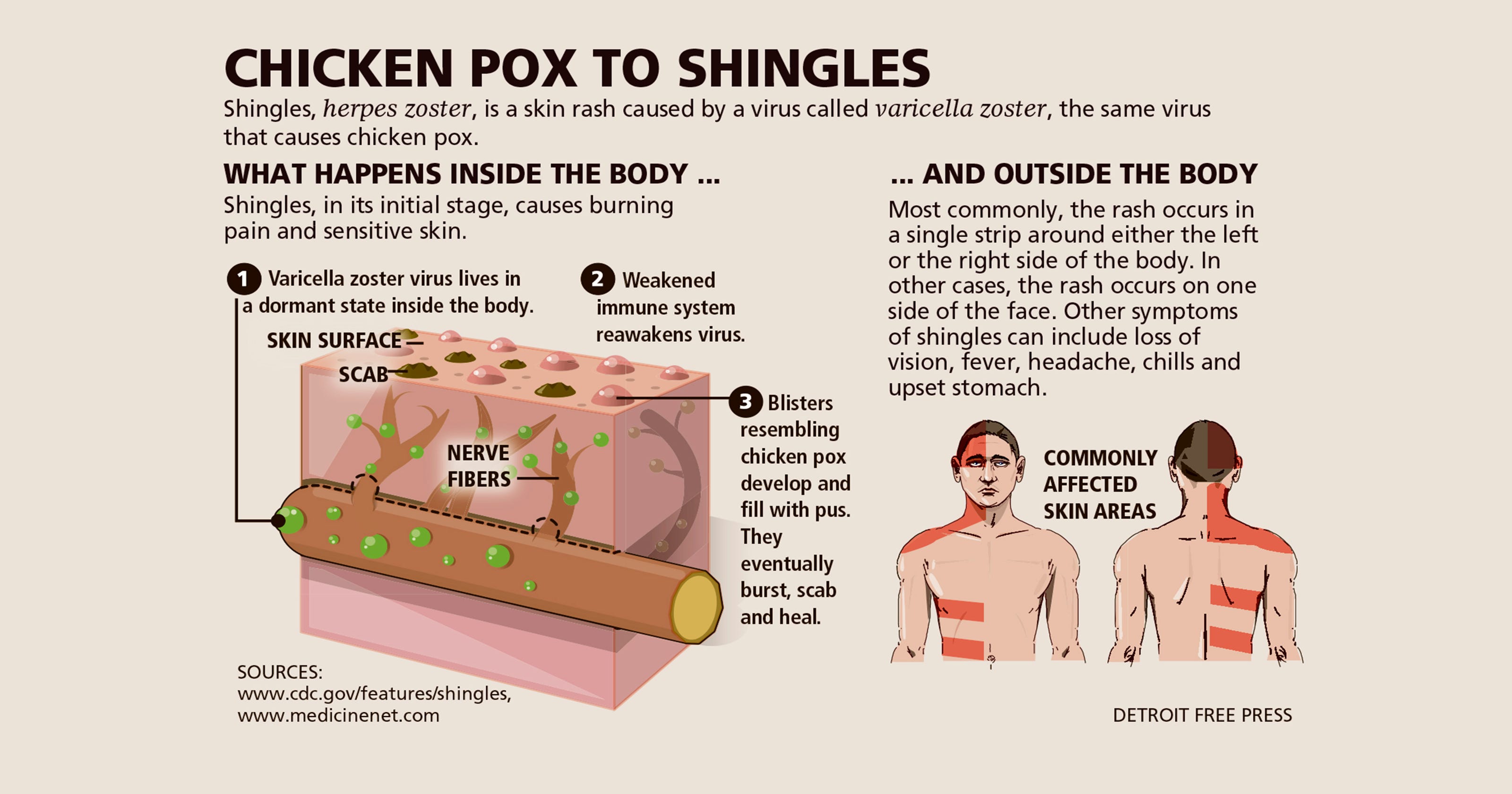 The Early Stages Of Shingles Signs And Symptoms - vrogue.co