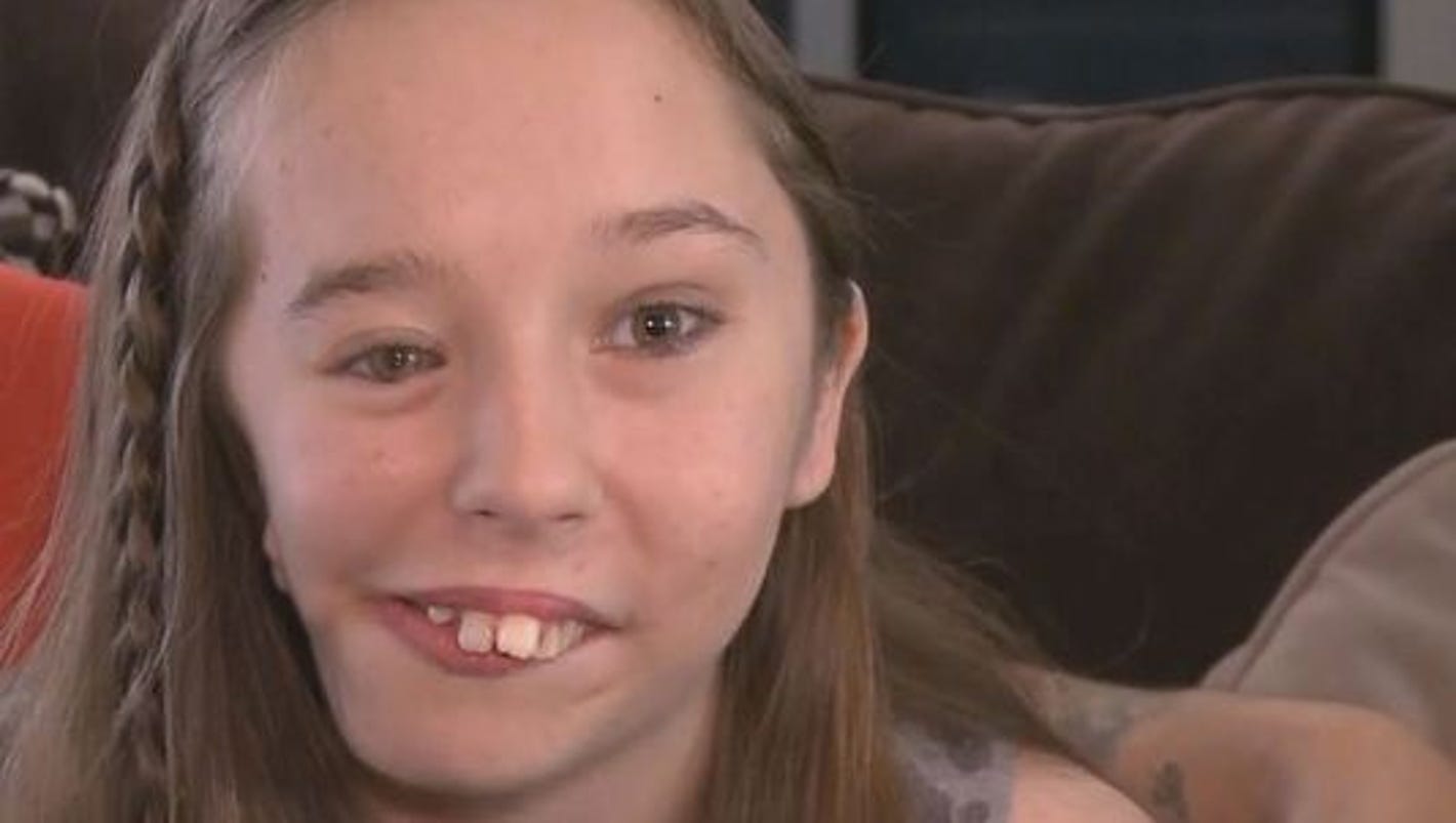Teen With Facial Deformity Finds Reason To Smile