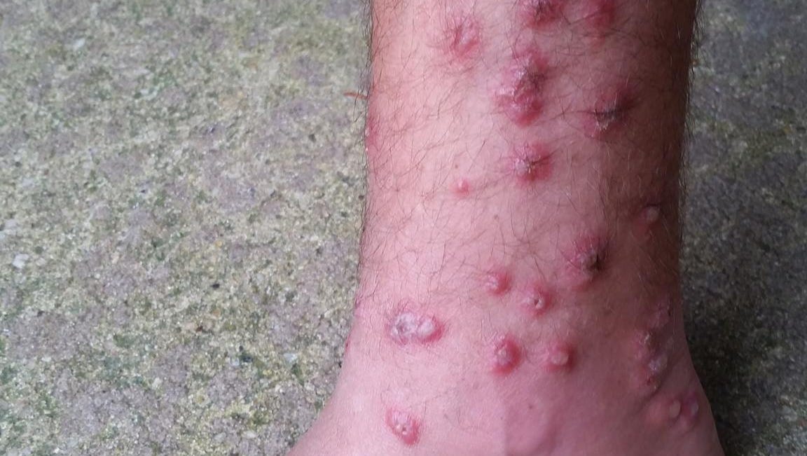 swimmers itch photos