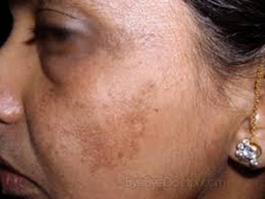 melasma-skin-condition-darkens-summer