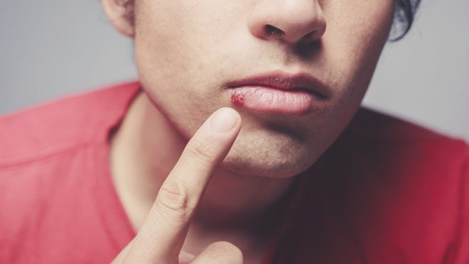 An increase in cold sores is possible because the winter season tends to reactivate the HSV-1 virus responsible for the sores, according to Abreva.
