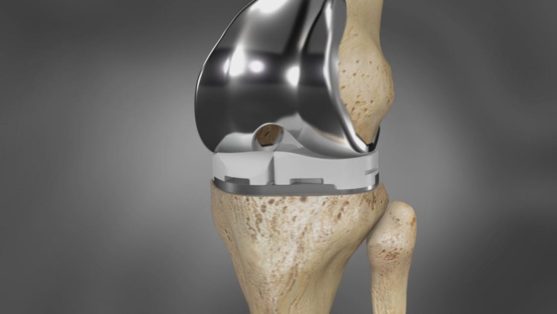 a-look-at-custom-knee-implants