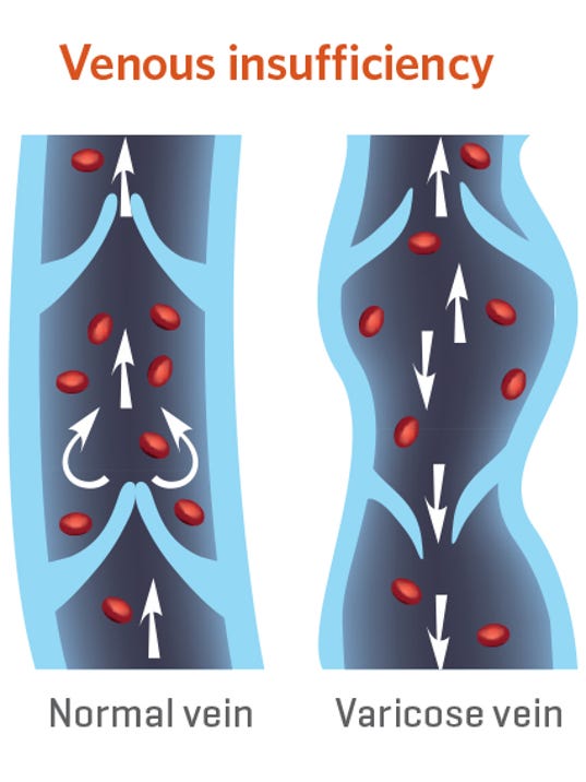 Chronic venous insufficiency: A condition affecting millions