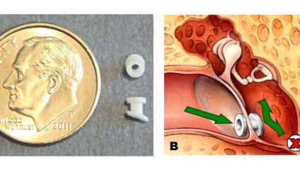 tube ear infection