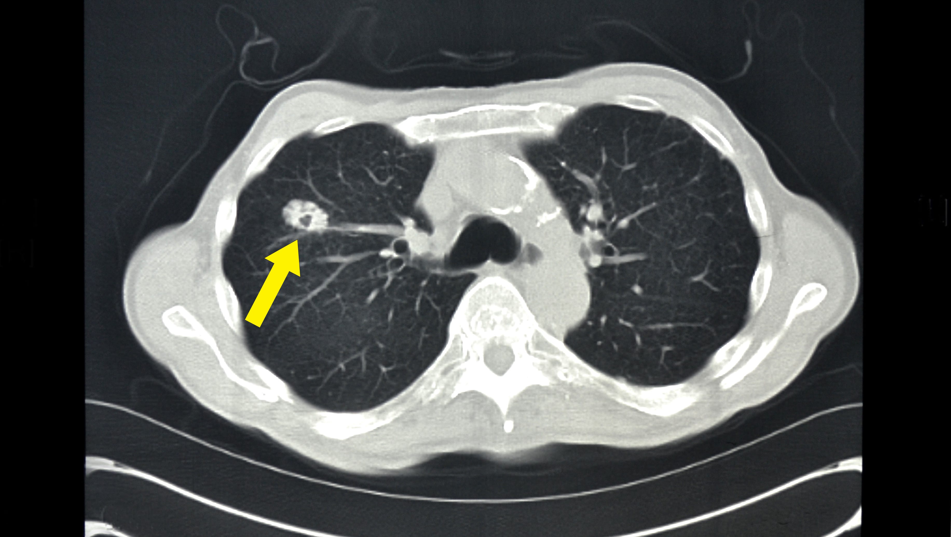 Getting Answers Quickly At The Lung Cancer Clinic