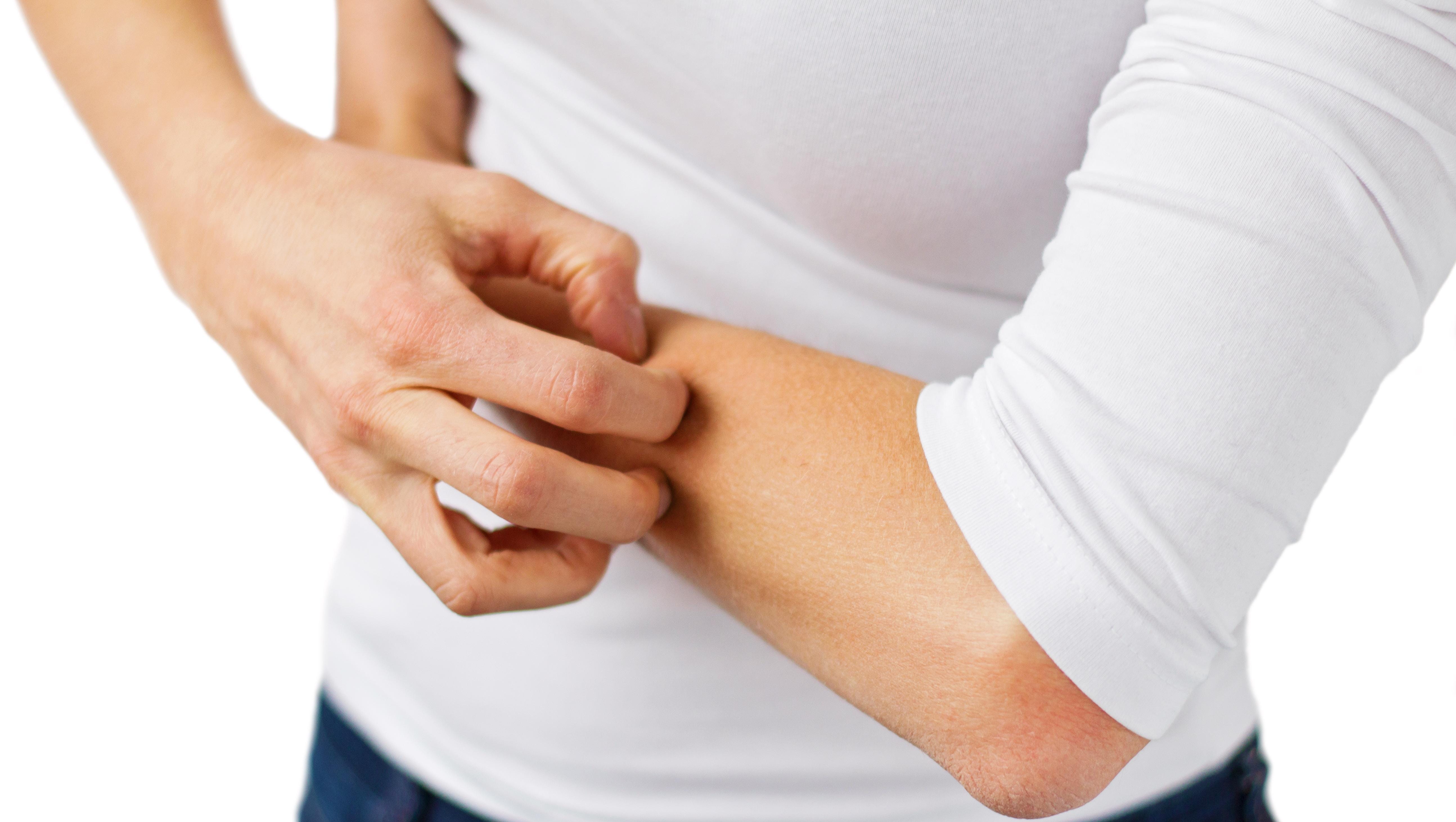 Hammerling Eczema Causes The Itch That Persists