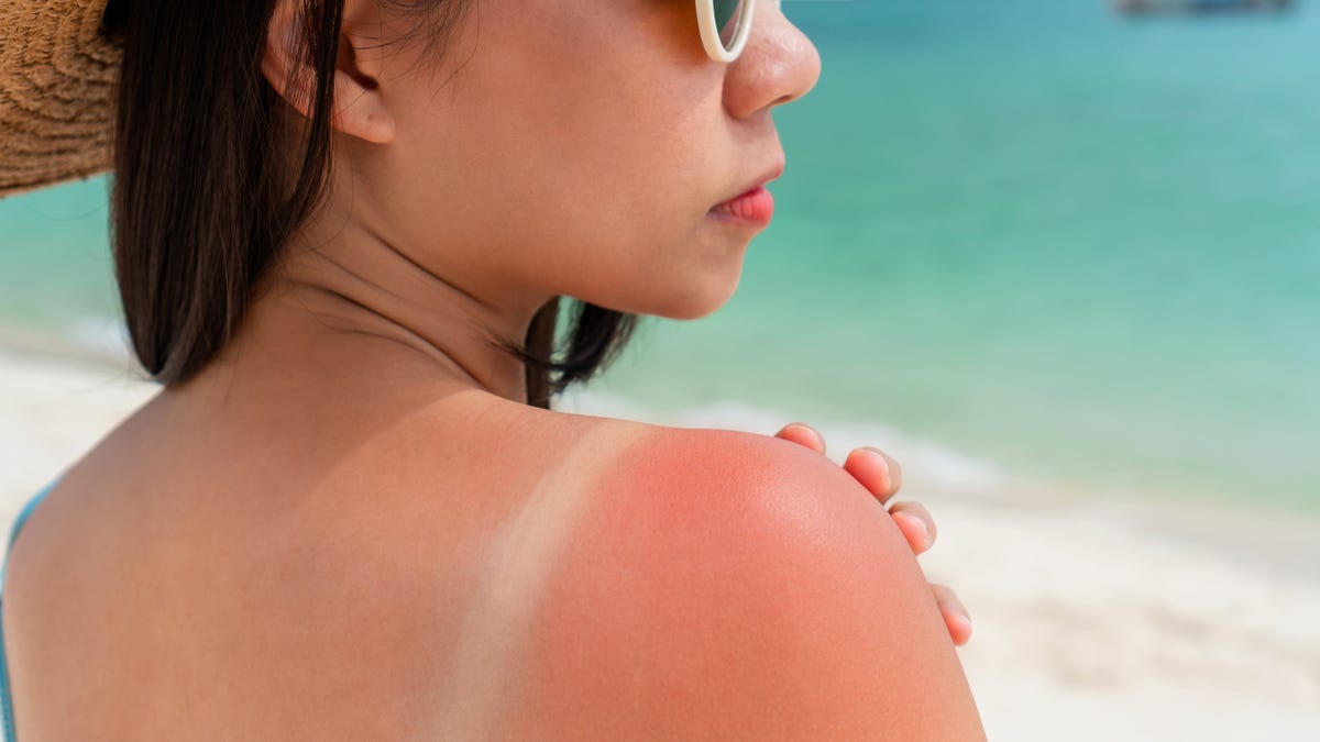 You are currently viewing How to get rid of sunburn quickly