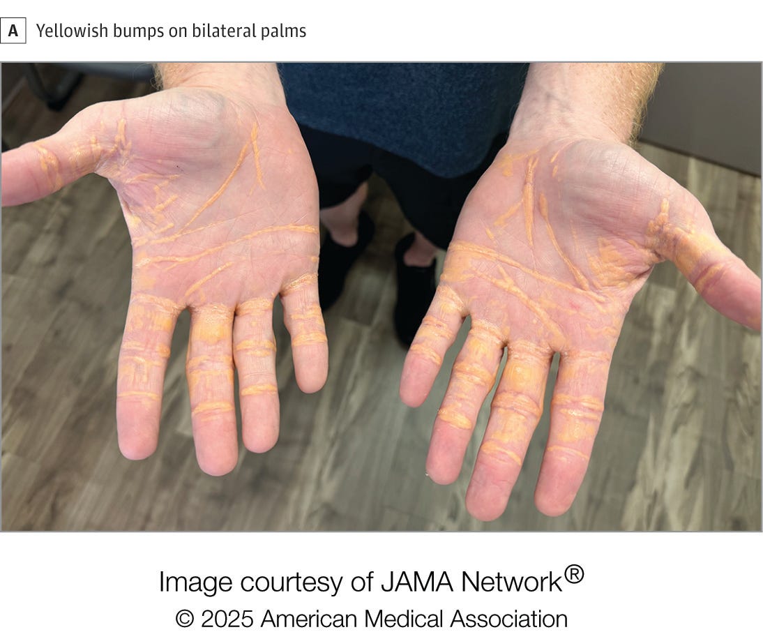 A man in his 40s experienced extremely high cholesterol levels after adhering to a carnivore diet, leading to cholesterol deposits appearing on his palms, elbows, and soles of his feet.