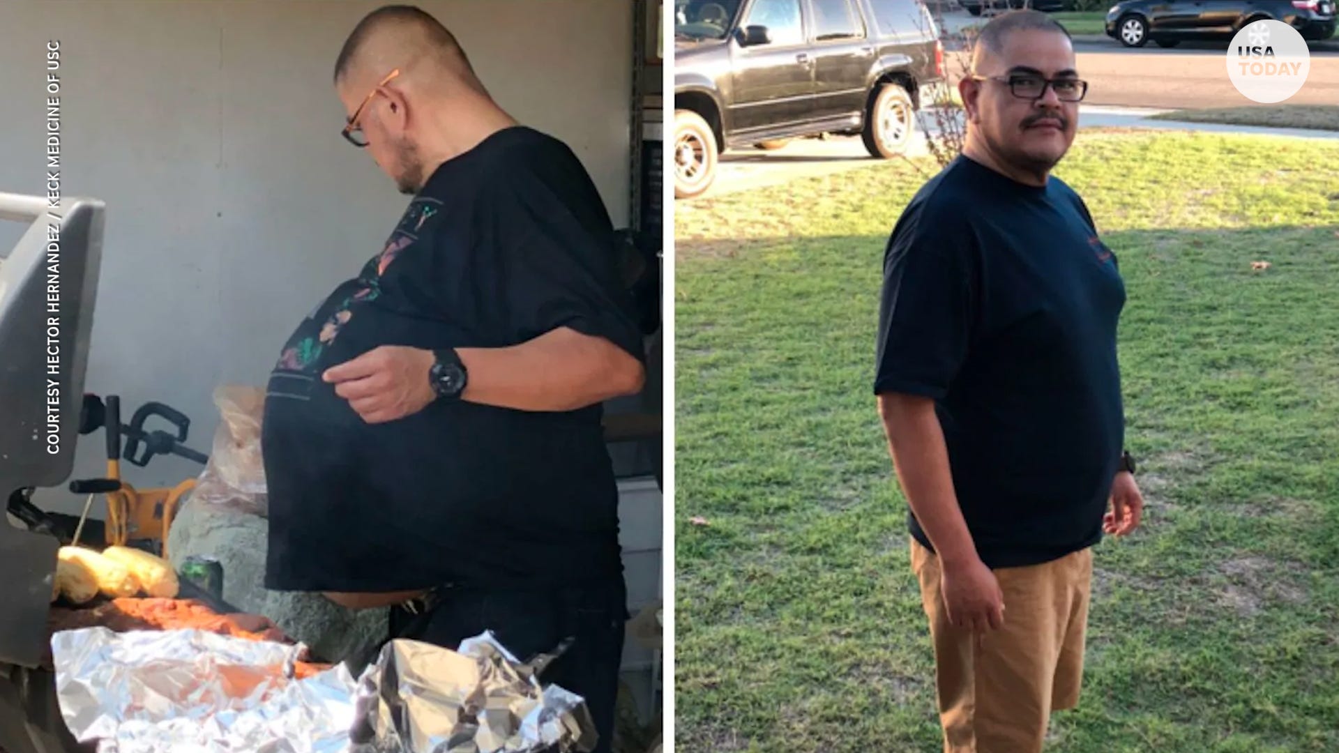 His Abnormal Beer Belly Was Actually A 77 Pound Tumor 