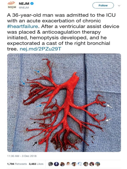 NEJM shares odd photo of blood clot shaped like lung. A man spit it up