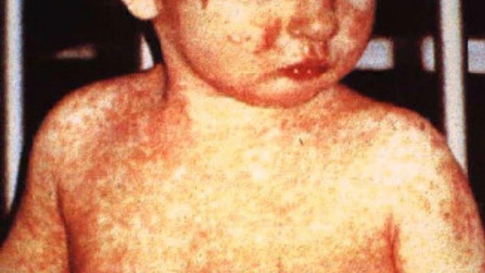 Measles Outbreak 900 Dead Madagascar Could That Happen In The U S
