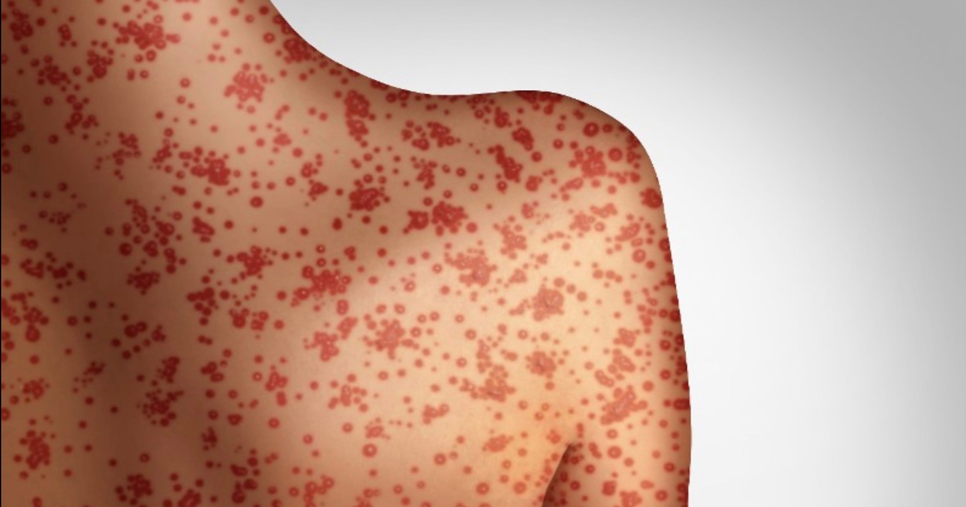 Measles arrives in Florida, what is it and what can you do?
