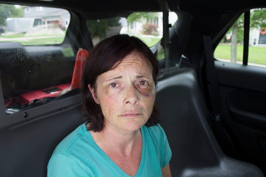 Tina Talbot’s injuries are photographed on Sept. 14, 2018, the day she was arrested in the fatal shooting of her husband, Milosz Szczepanowicz. This Waterford Police photo was provided to the Free Press by her friend, Janene Staley.