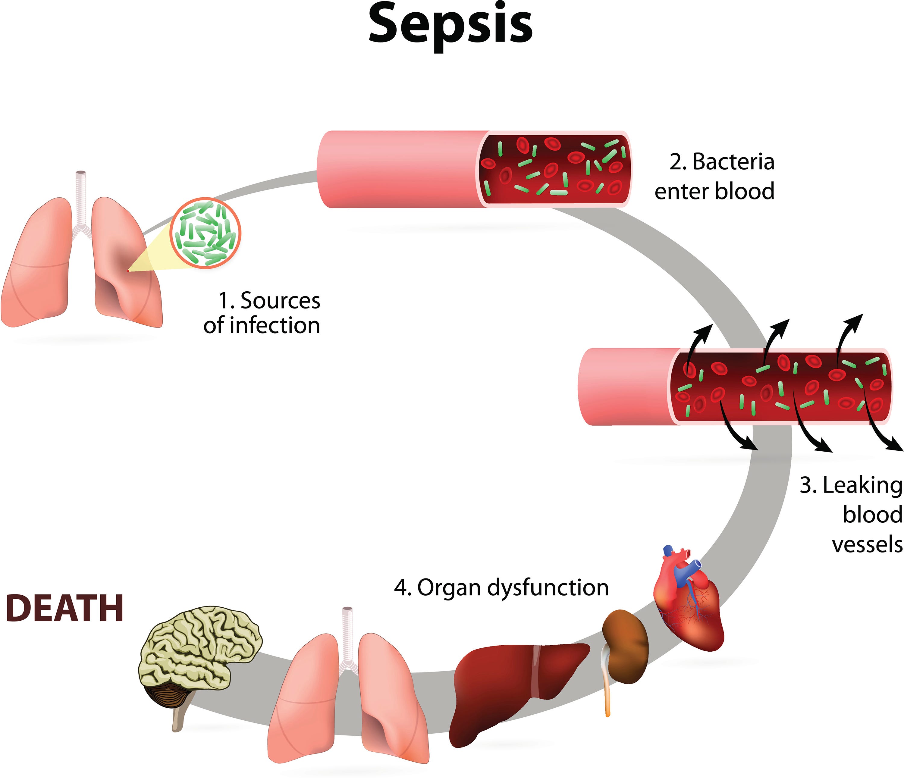 What You Need To Know About Sepsis In Children