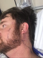 Tyler Hardy of Philadelphia, Mississippi, said the burning and swelling caused by the copperhead snake bite on his head Jan. 15, 2020, began spreading within minutes of the bite.