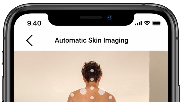 Automatic skin imaging by Miiskin app.