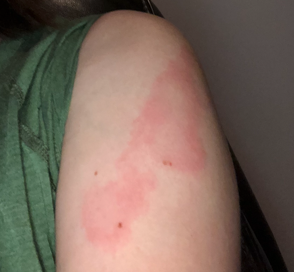 covid rash in adults treatment