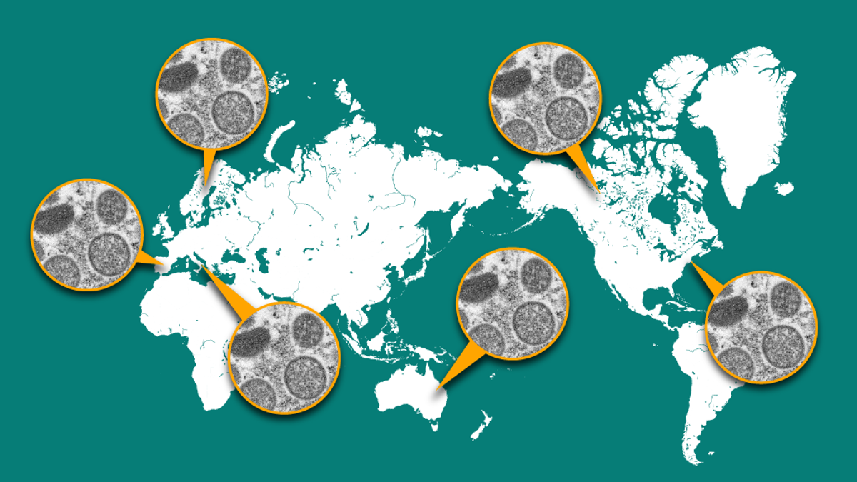 Monkeypox Outbreak 2024 In The United States Of America Sunny Ernaline