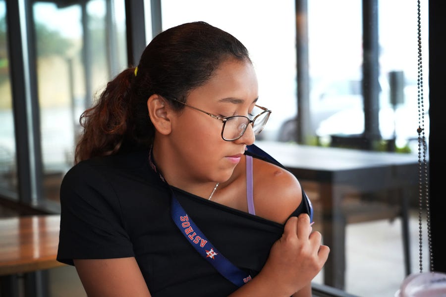 Miah Cerrillo, 11-years-old, shows bullet fragments that are still in her shoulder and her back from the day a gunman opened fire at Robb Elementary School killing 19 of her classmates in Uvalde. The shooting is the deadliest school shooting in Texas history.